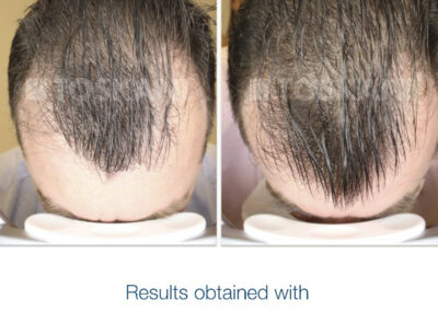 Vlasová mezoterapie MesojetGun - výsledek po 5 týdnech po ošetření