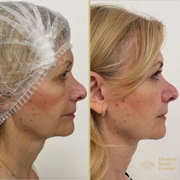 Před a po fotografie po zákroku Endolift - MUDr. Elizabeth Pavlíčková, PhD., Elizabeth Beauty Clinic